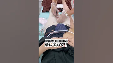 Thigh Liposuction Downtime Relieve The Pressure On Your Legs On The Third Day After Surgery S 