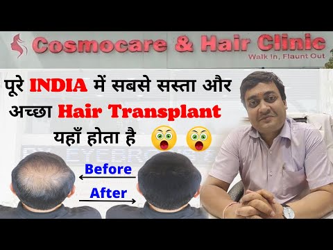 My hair Transplant journey till now | Cost of Hair transplantation | #satendersinghvlogs