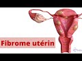 FIBROME UTERIN: QUELS SONT LES CAUSES ET SYMPTOMES?