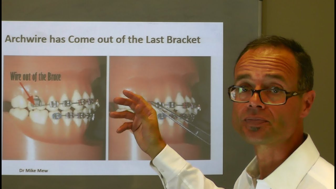 What to do at Home, If Archwire has Come out of the Last Orthodontic Bracket by Dr Mike Mew
