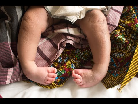 Hope Walks is Freedom from Clubfoot