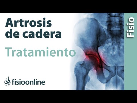 Vídeo: 5 Opciones De Tratamiento Para La Osteoartritis De La Cadera