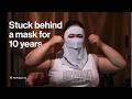 How Chronic Spontaneous Urticaria affected more than just her skin