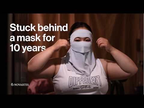 How Chronic Spontaneous Urticaria affected more than just her skin
