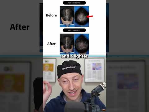 Is Clascoterone For Hair Loss TOO GOOD To Be True?