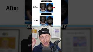 Is Clascoterone For Hair Loss TOO GOOD To Be True?