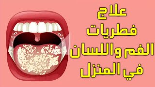 علاج فطريات الفم عند الاطفال والرضع والكبار ( علاج سريع لفطريات وقرح الفم واللسان وسببها )