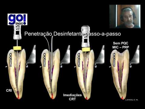 Vídeo: Periodontite Apical - Sintomas, Tratamento, Formas, Estágios, Diagnóstico