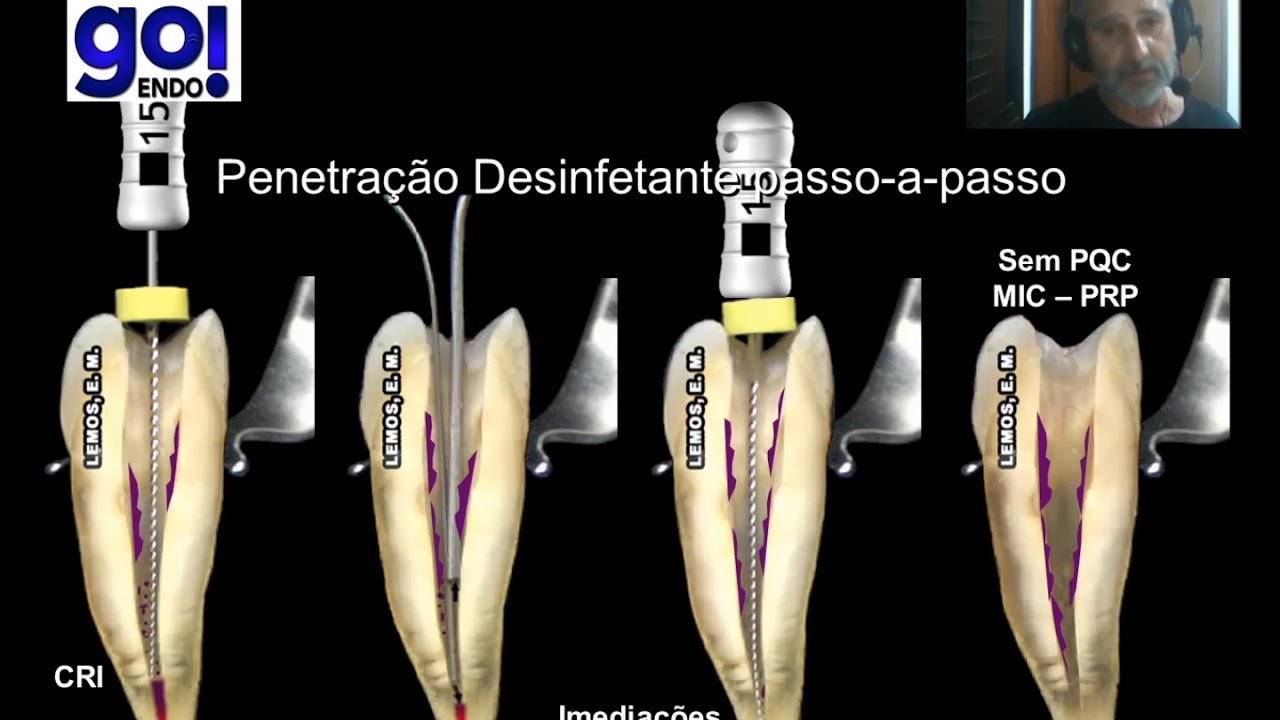 Periodontite Apical Sintomática Prof Érico Lemos