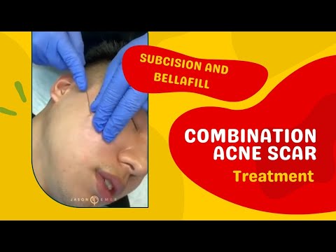 subcision-and-bellafill-|-combination-acne-scar-treatment-|-west-hollywood,-ca-|-dr.-jason-emer