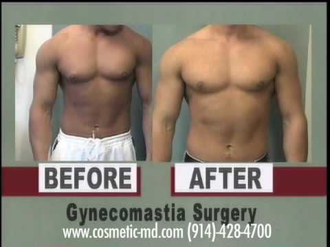 (914) 428-4700 Review Dr Blau's photos.A picture is worth a thosand words.Results Matter. Gynecomastia Connecticut CT Male Breast Reduction Bridgeport Hartford New Haven Stamford Waterbury. www.gynecomastiausa.com http www.cosmetic-md.com Mordcai Blau, MD, PC 12 Greenridge Ave. New York,White Plains 10605 Phone: 914-428-4700