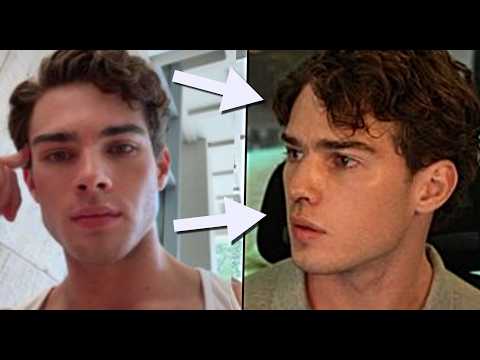 Streamer Clavicular BOTCHED nose job goes viral omg