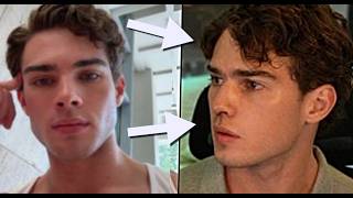Streamer Clavicular BOTCHED nose job goes viral omg