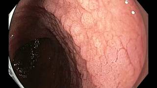 Celiac Disease March 3С