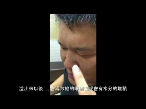 特殊且嚴重的鼻病~但又有點有趣... (鼻竇炎、流鼻水、過敏性鼻炎)