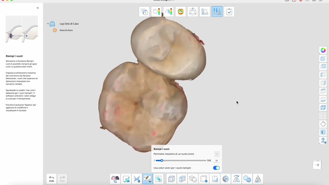 Medit Design “ Pre preparation Temporary Crowns  Project “ for Print Procedure