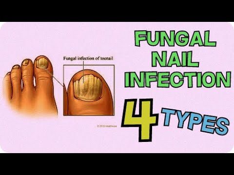 Toes Nail Fungus Treatment at best price in Noida | ID: 25916750273