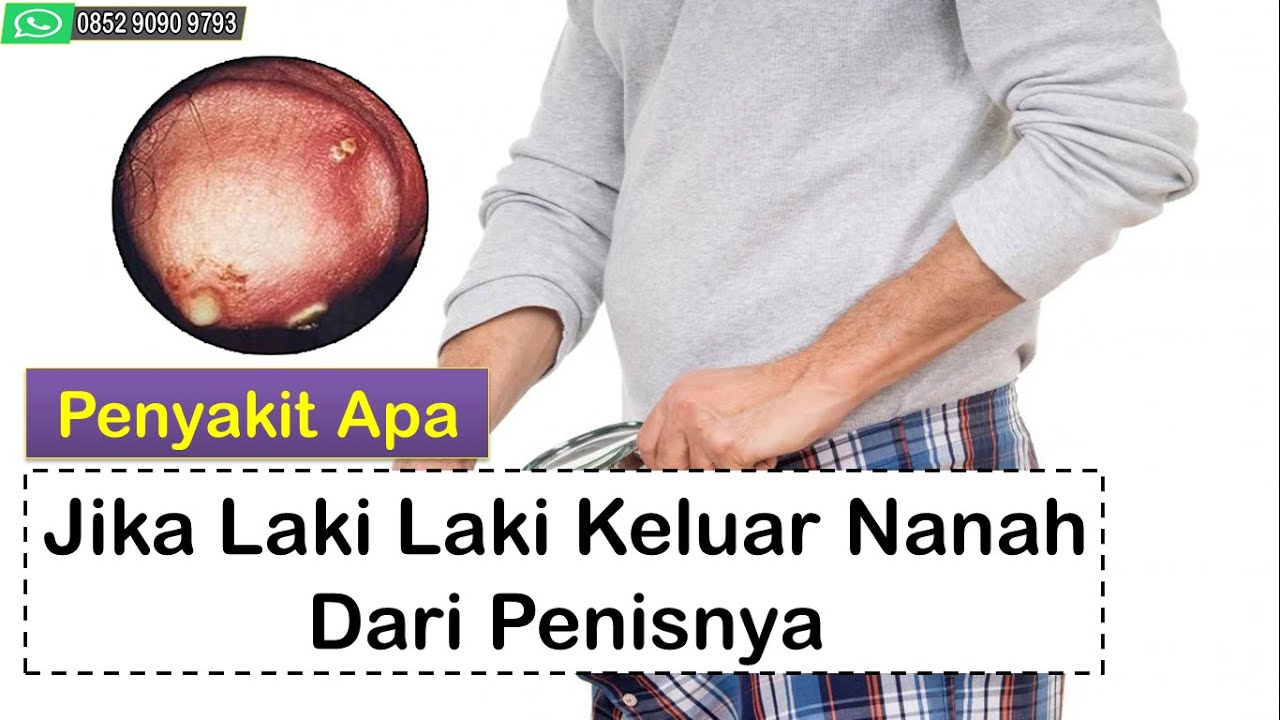 Penyakit Apa Jika Laki Laki Keluar Nanah Dari Penisnya 