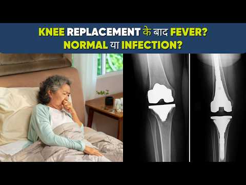 Fever After Knee Replacement: When Should You Worry? #kneereplacement #fever #postoprecovery