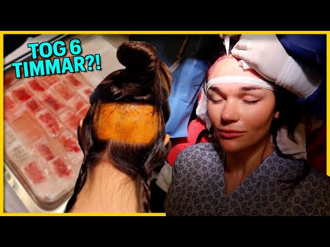 GÖR EN HÅRTRANSPLANTATION | Vlogg