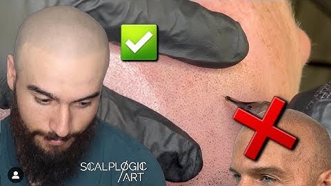 Everything you need to know about SMP | Scalp Micropigmentation
