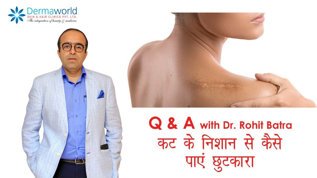 कट के निशान से कैसे पाएं छुटकारा Acne Scars Treatment In Hindi Dr