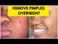 HOW TO REMOVE PIMPLES OVERNIGHT | ACNE TREATMENT