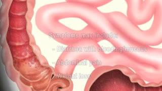 What is Ulcerative Colitis?  Meditoons™
