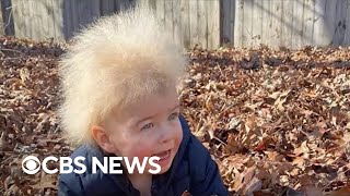 Boy has uncombable hair syndrome