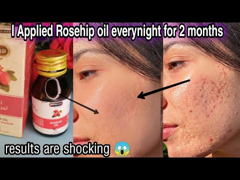 Video: Puas rosehip roj clog pores?