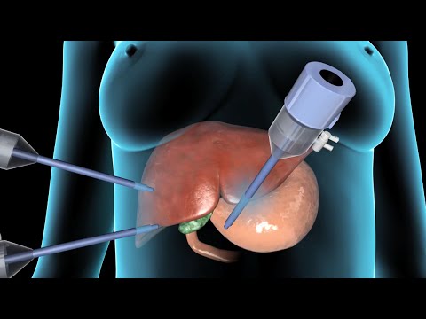 Cholecystectomy | Gallbladder Removal Surgery | Nucleus Health