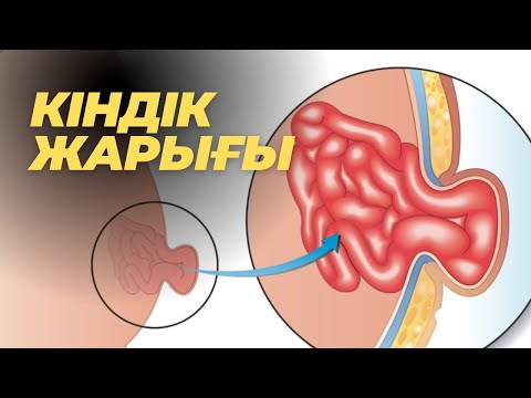 Video: Киндик гранулемасы бар баланы жуунта аласызбы?