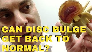 Can L4 L5 Disc Bulge Get Back To Normal Again? Does L5 S1 Disc Bulge Get Back To Normal Again?