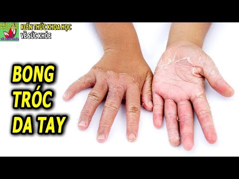 Video: Khắc phục sự cố của Cây Liễu - Lý do Để Vỏ Cây Liễu bị bong tróc