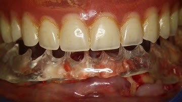 Straumann Pro Arch Video Dr Anand Krishnamurthy