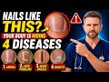 Neurologist Warns: If Your Nails Look Like This After 60, Your Body May Be Hiding 4 Diseases! 😨