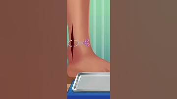 Ankle Fractures Treatment 😱 😱 #shorts #asmr