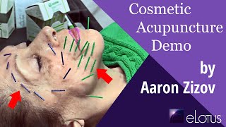 Cosmetic Acupuncture demo by Aaron Zizov screenshot 4