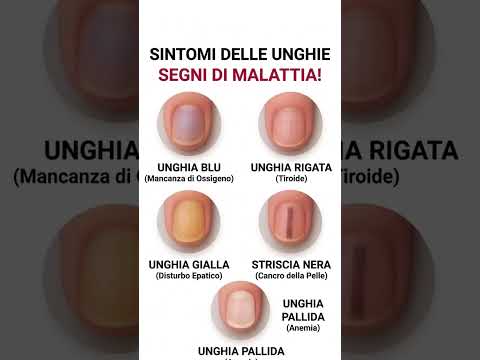 Video Sintomi delle unghie: segni di malattia da non ignorare