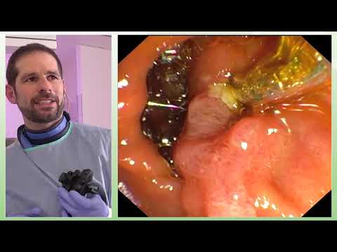 Video: Gallengangsobstruktion Bei Katzen