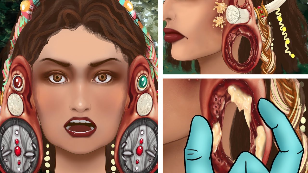 ASMRTreatment and removal of swelling caused by wearing large earrings