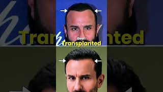 A restored hairline doesn’t always mean a perfect hair transplant. 👀
