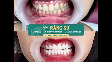 PHƯƠNG PHÁP KHẮC PHỤC THIỂU SẢN MEN RĂNG