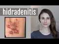 HIDRADENITIS SUPPURATIVA: Q&A WITH DERMATOLOGIST DR DRAY