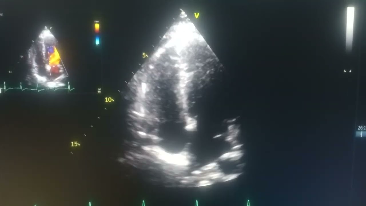 Normal Lv Function Normal Filling patten