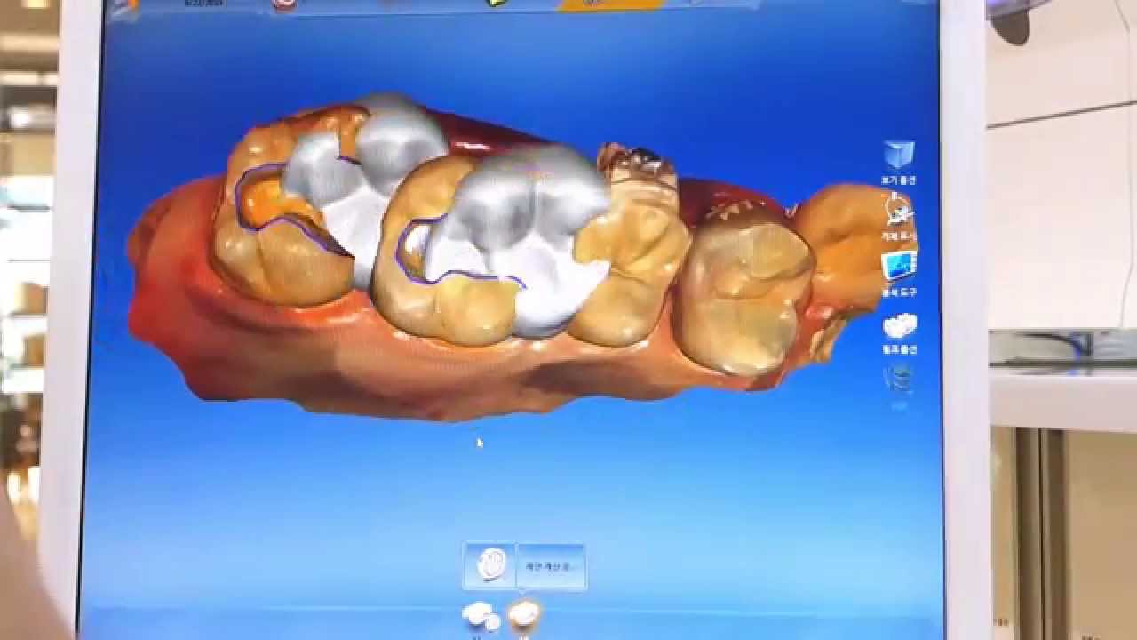 cerec inlays cerec inlays