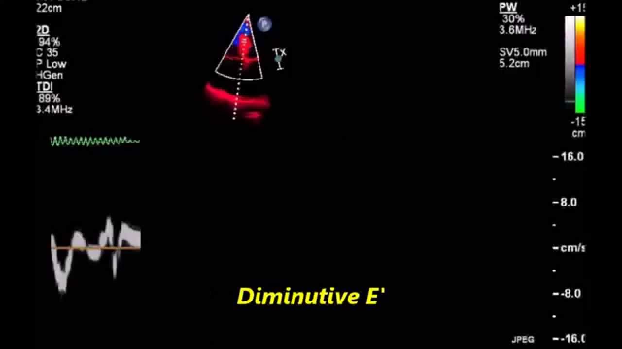 Hypertrophic cardiomyopathy with grade iii diastolic dysfunction youtube