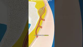 Download Lagu Laserbehandeling van pilonidale cysten (3D-animatie) #drone #theflash #space #automobile #scifi #burst MP3