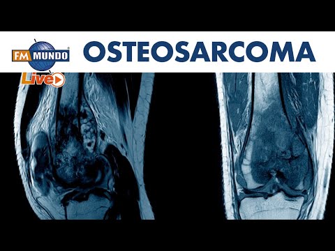 Vídeo: Osteosarcoma (osteosarcoma): Causas, Síntomas Y Tratamiento Del Osteosarcoma