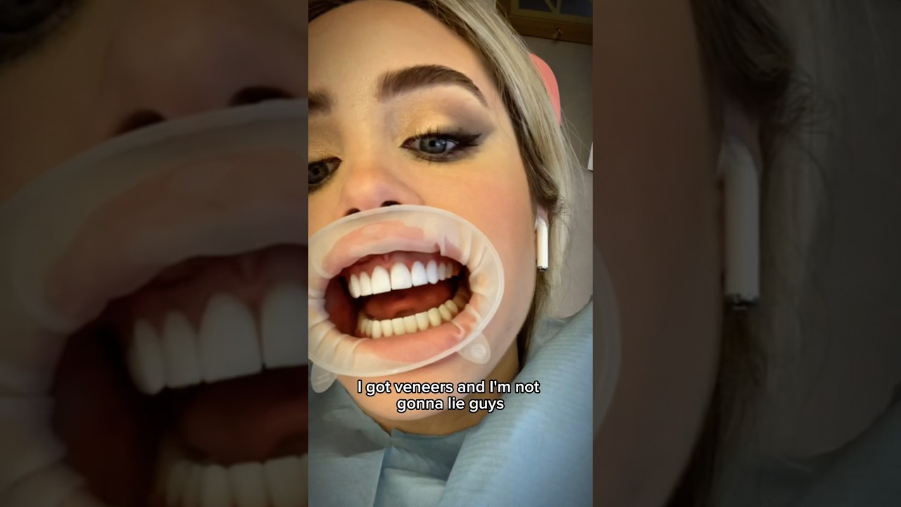 БЕСПЛАТНЫЕ ВИНИРЫ?!